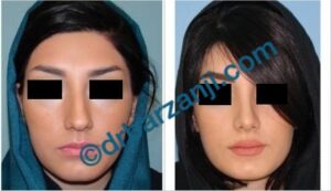 جراحی بینی یک سال و نیم بعد از عمل