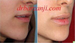 تزریق فیلر ژوویدرم در لب