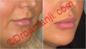 تزریق ژل جوویدرم ( ژوویدرم ) به لب پانزده ماه بعد
