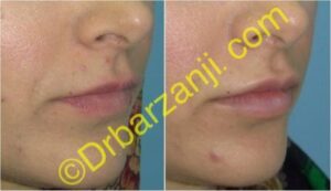 تزریق ژل جوویدرم ( ژوویدرم ) به لب یک هفته بعد