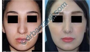 جراحی پلاستیک بینی یک سال بعد از عمل