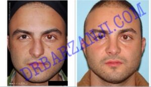 عمل جراحی پلاستیک بینی ٢ سال بعد