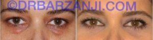 جراحی پلک بالا و پایین، دو ماه بعد از عمل