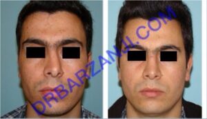 جراحی بینی، شش ماه بعد از عمل