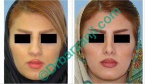 جراحی پلاستیک بینی شش ماه بعد از عمل