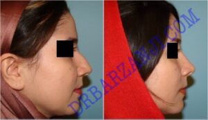 جراحی بینی، ۶ ماه بعد از عمل