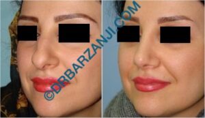 جراحی بینی یک سال بعد از عمل