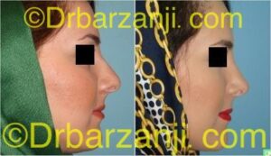 عمل جراحی زیبایی بینی یک سال بعد