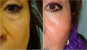 عمل جراحی پلک (بلفاروپلاستی) تحتانی