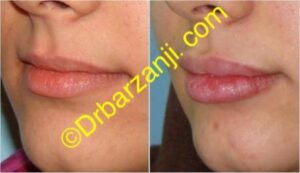 تزریق ژل ژوویدرم به لب