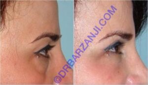 جراحی پلک بالا و پایین و تزریق چربی