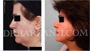 لیفت صورت و گردن