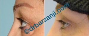 جراحی پلک بالا