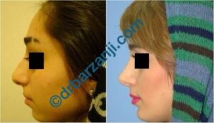 جراحی بینی و پروتز چانه چهار سال بعد از عمل