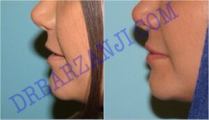 تزریق ژل رستیلن در لب