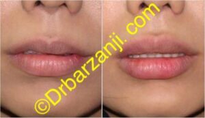 تزریق ژل ژوویدرم به لب