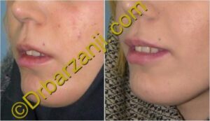 تزریق ژل لب