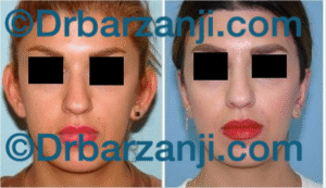 جراحی پلاستیک لاله گوش یک سال بعد از عمل