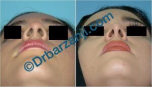 جراحی پلاستیک بینی نه ماه بعد از عمل