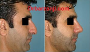 یک ماه بعد از جراحی بینی