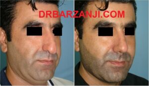 یک ماه بعد از جراحی بینی