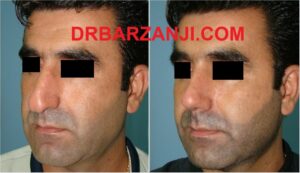 یک ماه بعد از جراحی بینی