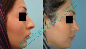 عمل جراحی پلاستیک بینی ( رینوپلاستی )