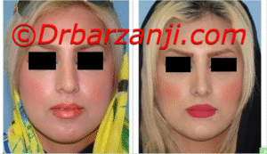 جراحی بینی و پروتز چانه و گونه شش ماه بعد