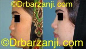 جراحی پلاستیک با پیوند غضروف دنده به بینی