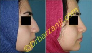 جراحی بینی گوشتی یک سال بعد از عمل