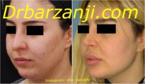 تزریق ژل جوویدرم در لب