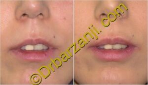 تزریق ژل لب