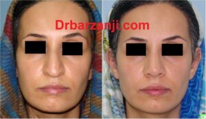 چهار ماه بعد از جراحی بینی