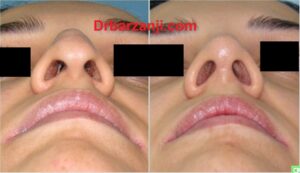 چهار ماه بعد از جراحی بینی