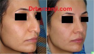 چهار ماه بعد از جراحی بینی