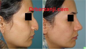 چهار ماه بعد از جراحی بینی