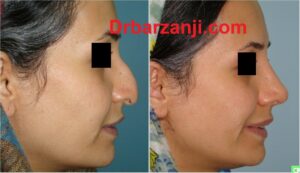 چهار ماه بعد از جراحی بینی