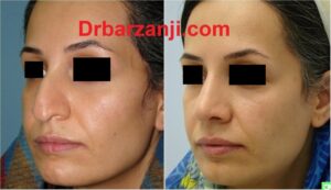 چهار ماه بعد از جراحی بینی
