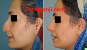 چهار ماه بعد از جراحی بینی