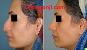 چهار ماه بعد از جراحی بینی