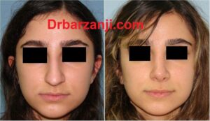 یک سال و نیم بعد از رینوپلاستی