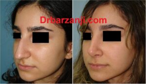 یک سال و نیم بعد از رینوپلاستی