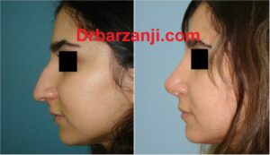 یک سال و نیم بعد از رینوپلاستی