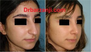 یک سال و نیم بعد از رینوپلاستی