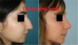 یک سال و نیم بعد از رینوپلاستی