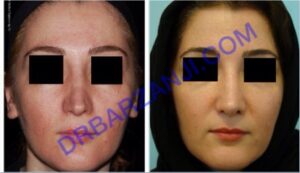 رینوپلاستی ثانویه