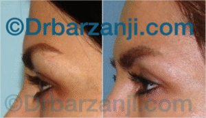 جراحی پلاستیک پلک بالا