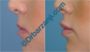 تزریق ژل جوویدرم ( ژوویدرم ) به لب