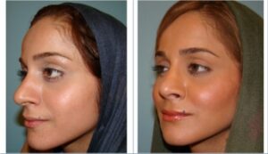 پروتز گونه وجراحی بینی، ٣ماه بعد از عمل