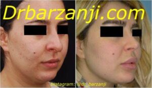 تزریق ژل جوویدرم در لب